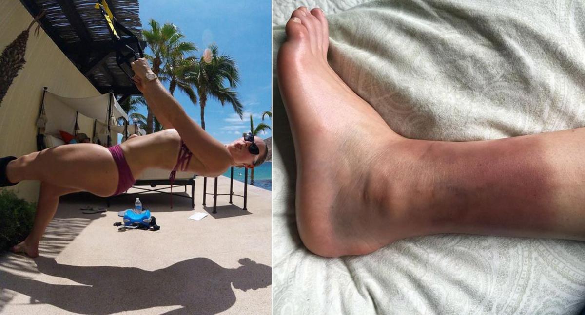 Lindsey Vonn shares photo of fractured ankle and while working out.